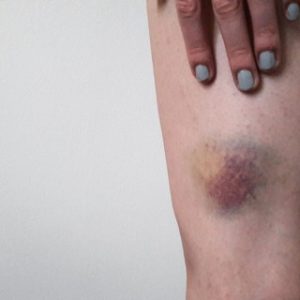 Bruises