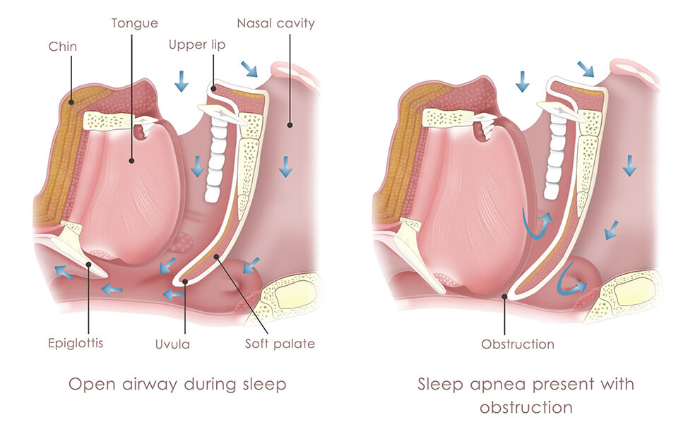 sleep apnea 4
