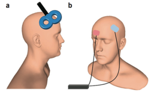 Working of Transcranial Stimulation Therapy