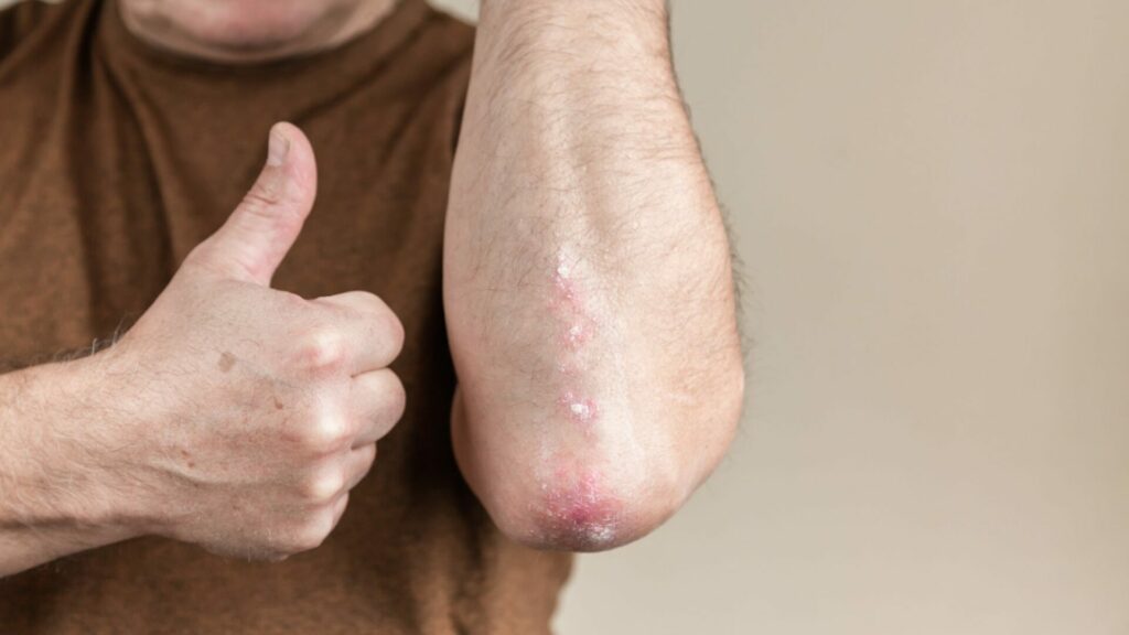 Signs of Excoriation Disorder
