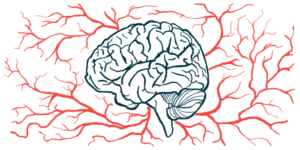 deep brain stimulation