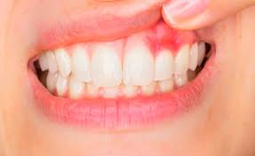 Problems with teeth or gums