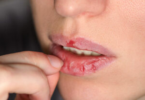 Habit Reversal Training for Skin Picking: How to Stop Peeling Your Skin