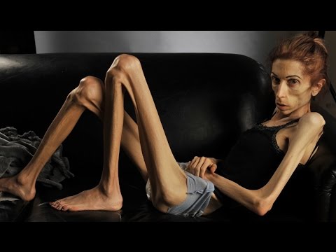 Severe anorexia: Understanding the condition