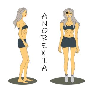 What Is Severe Anorexia?